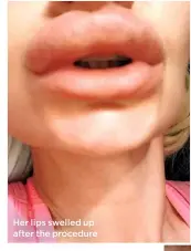  ??  ?? Her lips swelled up after the procedure