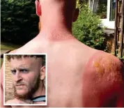  ??  ?? Painful: Greg Binnie and his sunburn