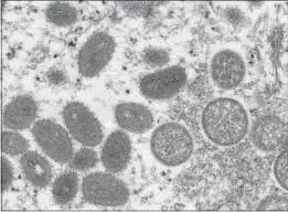  ?? THE ASSOCIATED PRESS ?? This 2003 electron microscope image made available by the Centers for Disease Control and Prevention shows mature, oval-shaped monkeypox virions, left, and spherical immature virions, right, obtained from a sample of human skin associated with the 2003 prairie dog outbreak.