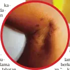  ??  ?? KESAN lebam yang ditemui pada badan dua beradik perempuan dipercayai didera.