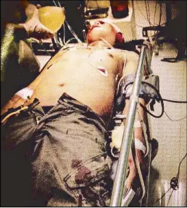  ??  ?? Police Officer 3 Junio Hilario lies on a gurney at the Dr. Jose N. Rodriguez Memorial Hospital yesterday. REY GALUPO