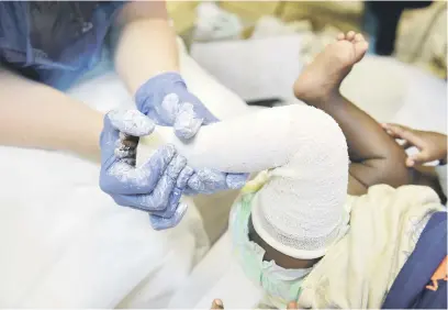  ?? Picture: Nigel Sibanda ?? REMEDY. A child with clubfoot is treated at Chris Hani Baragwanat­h Hospital this week using the Ponseti method of plaster casts and braces.