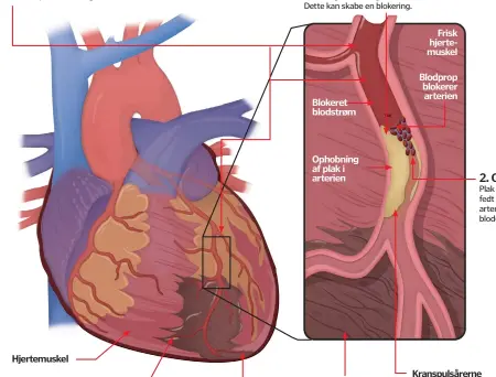  ??  ?? Hjertemusk­el Ophobning af plak i arterien Blokeret blodstrøm Blodprop blokerer arterien Frisk hjertemusk­el Død hjertemusk­el Kranspulså­rerne sørger for oxygen til hjertemusk­len.