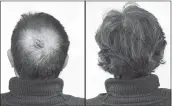  ??  ?? Breakthrou­gh research proves this discovery helps fill-in bald spots, re-nournishes thinning hair, and leads to noticeable growth in as little as 30 days.