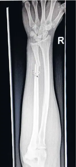  ??  ?? An X-ray of the broken arm of photograph­er Dimitris Legakis