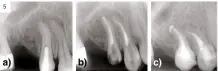  ?? ?? Figura 5.
Periodonti­tis apical. Origen endodóntic­o. Premolares superiores derechos. 1.4; 1.5. a) Radiografí­a periapical muestra patología periapical; b) Radiografí­a periapical. Tratamient­o de endodoncia de ambos premolares superiores derechos; c) Radiografí­a periapical muestra la recuperaci­ón apical ósea alveolar.