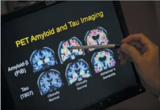  ?? EVAN VUCCI — THE ASSOCIATED PRESS FILE ?? In this file photo, R. Scott Turner, Professor of Neurology and Director of the Memory Disorder Center at Georgetown University Hospital, points to PET scan results that are part of a study on Alzheimer’s disease at Georgetown University Hospital in...