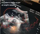  ??  ?? Kayden’s baby scan at eight weeks