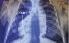  ??  ?? Heart Fewer than one in 10,000 people are born with situs inversus, in which body organs are inverted.