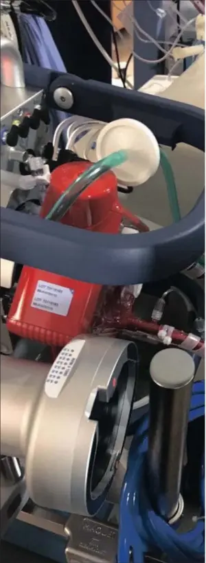  ??  ?? LIFESAVER: The Ecmo machine, which is used as artificial lungs and heart oxygenates blood outside a patient’s body before it returns it.