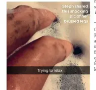  ??  ?? Steph shared this shocking pic of her bruised legs