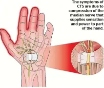  ??  ?? The symptoms of
CTS are due to compressio­n of the median nerve that supplies sensation and power to part
of the hand.