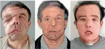  ?? PHOTO: AP ?? These photos show Jerome Hamon before and after his two face transplant­s. The second transplant, after the first one showed signs of rejection, was a medical first, and Hamon is now doing well.