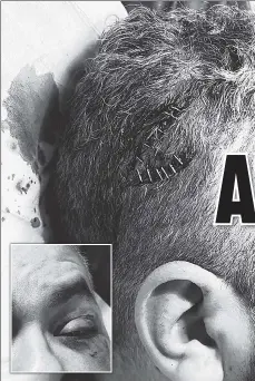  ?? ?? ‘UNPROVOKED
ASSAULT’: A Rikers Island correction officer needed stitches to close a head wound (top left), suffered a battered left eye (lower left) and had 10 teeth knocked out in a violent attack allegedly at the hands of inmate Julius Allen, who’s been held at the facility since Feb. 27 in connection with a murder by gunfire in Brooklyn.