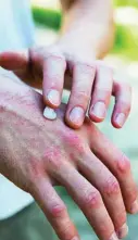  ??  ?? La psoriasis afecta al 2% de la población