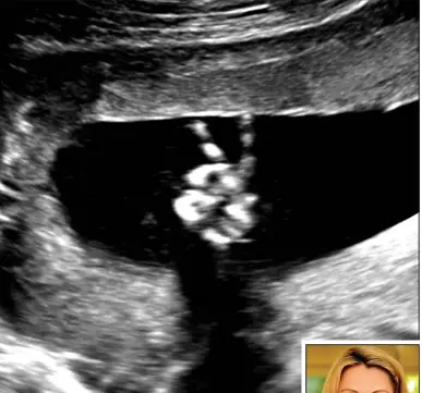  ??  ?? Comforting gesture: The child gives the V-sign in a 20-week scan