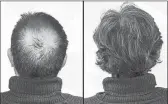  ??  ?? Breakthrou­gh research proves this discovery helps fill-in bald spots, re-nournishes thinning hair, and leads to noticeable growth in as little as 30 days.