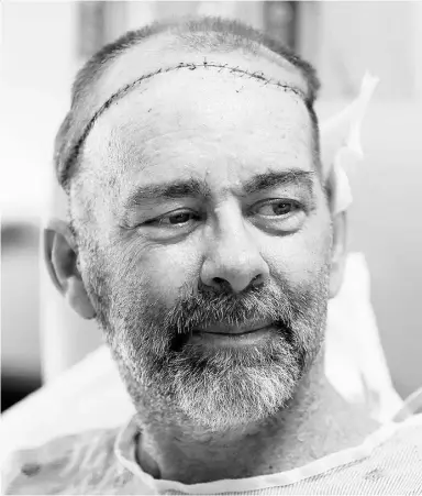  ?? Pat Sullivan /TheAssocia­ted Pres ?? James Boysen of Austin, Texas, says he was stunned at how well doctors matched him to
a donor with similar skin and colouring for his partial skull and scalp transplant.