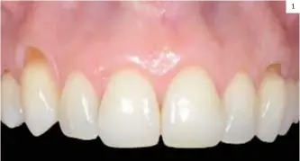  ??  ?? Imagen 1. Situación clínica basal que presenta recesiones gingivales en 13 y 23. 1