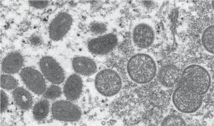  ?? / AP ?? DISEASE. This 2003 electron microscope image made available by the Centers for Disease Control and Prevention shows mature, oval-shaped monkeypox virions, left, and spherical immature virions, right, obtained from a sample of human skin associated with the 2003 prairie dog outbreak. Monkeypox, a disease that rarely appears outside Africa, has been identified by European and American health authoritie­s in recent days.