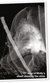  ??  ?? CT scan of Molly’s chest showing the stick