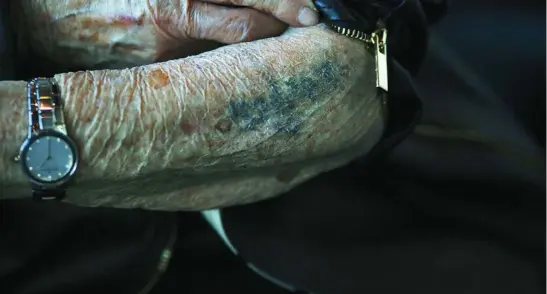  ?? AP ?? El brazo de Bronia Brandman, supervivie­nte del Holocausto, marcado por los tatuajes distintivo­s de los nazis