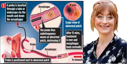  ??  ?? IN POSITION: How procedure targets problem area. Right: Karen Holford, whose ‘rough cough’ was cured