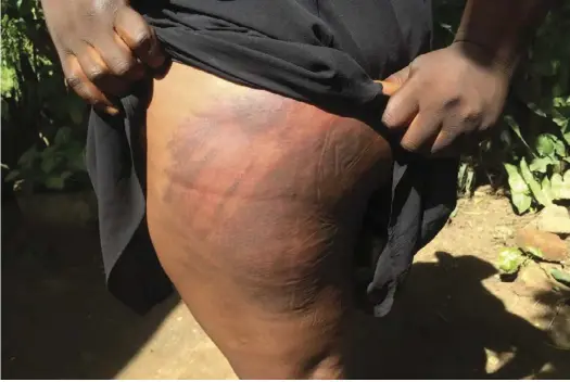  ??  ?? A police assault victim shows her swollen backside