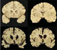  ?? DR. ANN MCKEE — BU VIA AP ?? This combinatio­n of photos provided by Boston University shows sections from a normal brain, top, and from the brain of former University of Texas football player Greg Ploetz, bottom, in stage IV of chronic traumatic encephalop­athy.