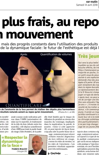  ?? (Photos N. C. et DR) ?? Une meilleure analyse de l’anatomie de la face permet de réaliser des dépôts plus harmonieux de produits, pour des résultats naturels autant au repos qu’en mouvement.