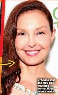  ??  ?? Dr Spano says she may also have had dermal filler in her cheeks.