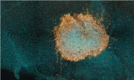  ?? Photograph: ICR London/PA ?? Human DIPG cells (orange) grown on a mouse brain ‘slice’ (light blue), treated with the drug combinatio­n and showing cells dying in the middle.