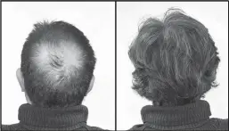  ?? ?? Breakthrou­gh research proves this discovery helps fill-in bald spots, renournish­es thinning hair, and leads to noticeable growth in as little as 30 days.