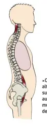  ??  ?? Columna con alteracion­es en sus curvas donde aumenta el tono muscular de flexores de cadera y trapecios