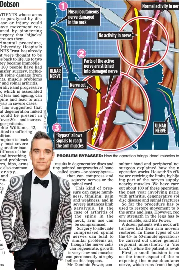  ??  ?? SUFFERER: Robbie Williams PROBLEM BYPASSED: How the operation brings ‘dead’ muscles to life
