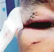  ?? PIC COURTESY OF READER ?? The stitches on the ambulance driver’s right brow.