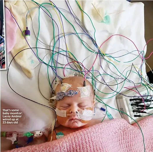  ??  ?? That’s some baby monitor: Lacey Ambler wired up at 23 days old
