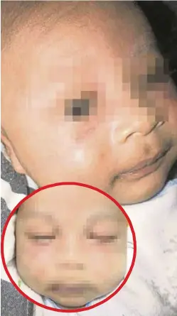  ??  ?? BAYI lelaki berusia dua bulan yang dipercayai dipukul dan dicubit pengasuhny­a di Taman Equine, Serdang, 23 Oktober lalu.