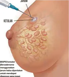  ??  ?? BIOPSI ketulan fibroadeno­ma menggunaka­n jarum halus diperlukan untuk mendapat diagnosa yang tepat.