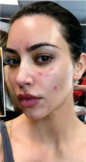  ??  ?? Make-up free: Kim Kardashian shares a photo of her psoriasis