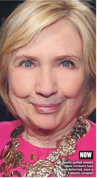  ??  ?? Overly puffed cheeks make Clinton’s face look distorted, says a
plastic surgeon NOW