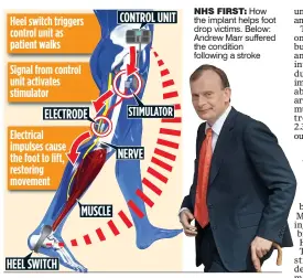  ??  ?? NHS FIRST: How the implant helps foot drop victims. Below: Andrew Marr suffered the condition following a stroke