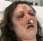  ??  ?? Ordeal: Her nose was shattered