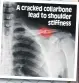  ?? ?? A cracked collarbone lead to shoulder stiffness