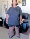  ?? Supplied ?? LYMPHOEDEM­A and elephantia­sis robbed her of a normal life, says Charlene Moses, 50, of Hangberg. She hopes the City will help her achieve a degree of freedom in a convenient ground floor council flat. |