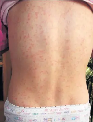  ??  ?? The fine, red, itchy rash caused by scarlet fever