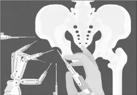  ?? GRACIA LAM / THE NEW YORK TIMES ?? The last decade has seen significan­t incrementa­l improvemen­ts in surgical techniques and the ability to fit patients with artificial hips that are highly resistant to mechanical failure or a need for revision.