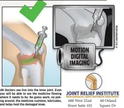  ??  ?? JRI Doctors see live into the knee joint. Even you will be able to see the medicine flowing where it needs to be. No guess work, no poking around, the medicine cushions, lubricates, and helps heal the damaged knee.
