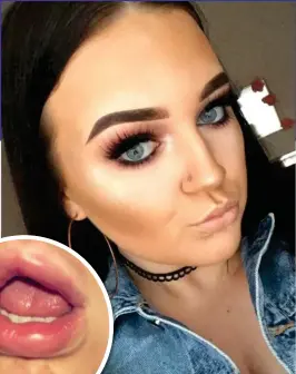  ?? ?? BOTCHED: Catrina Banks suffered lumps in her lips and cheeks from having filler injected