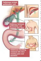  ??  ?? Gallstones irritate gallbladde­r wall Gallstone between gallbladde­r and common bile duct Gallstones blocking common bile duct causing pain and jaundice.